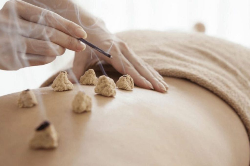 Moxibustion mit glimmendem Moxa aus Gemeinem Beifuß (Artemisia vulgaris) auf dem Rücken einer Person.